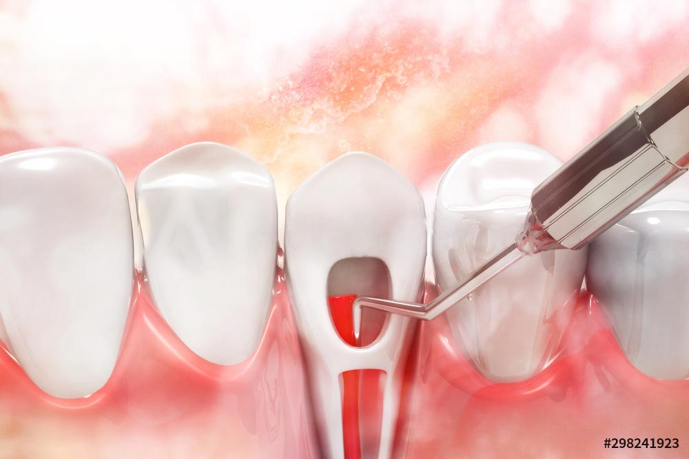 root-canal-treatment-canberra